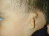 Atresia ear 1